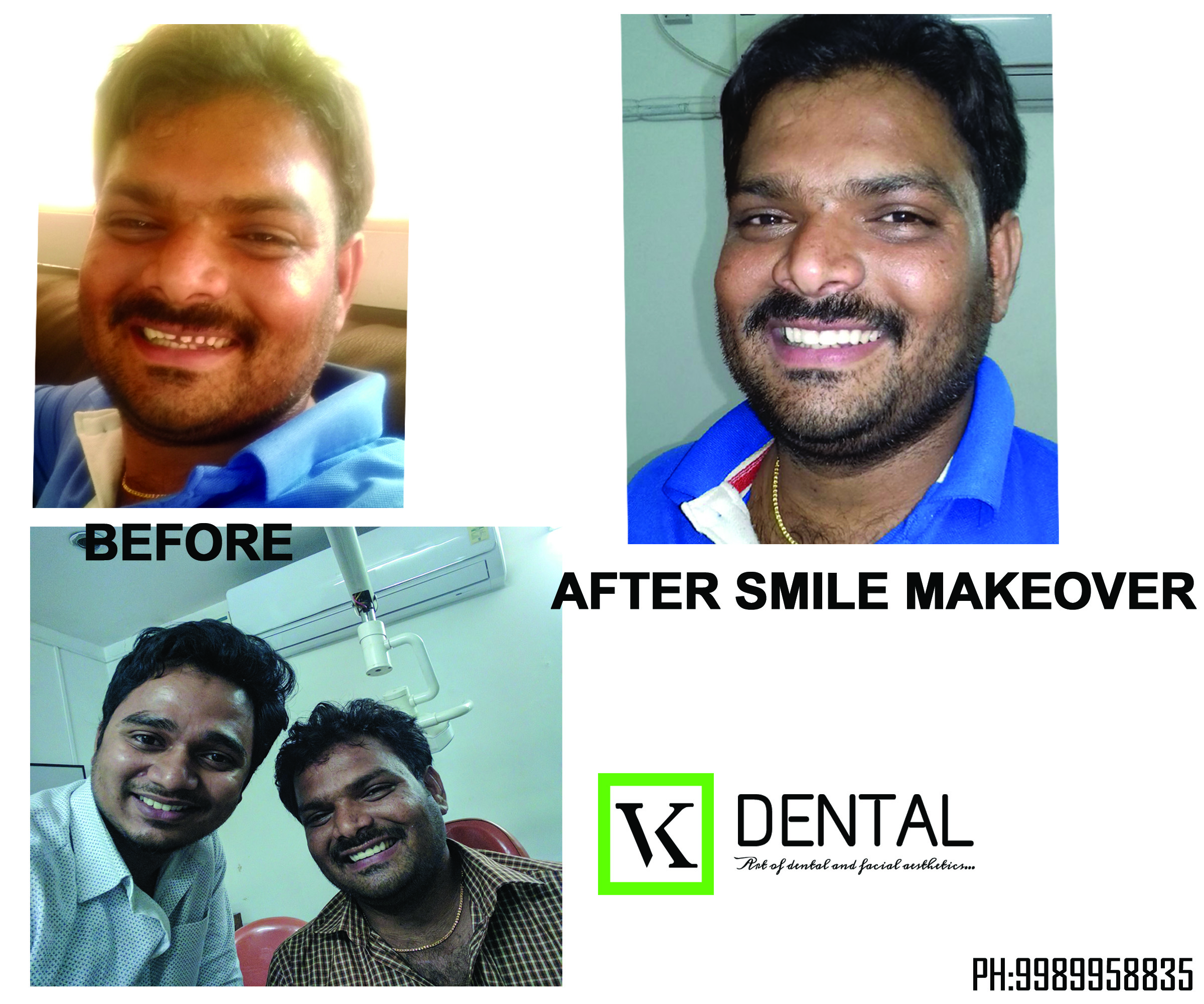 SMILE CORRECTION/DESIGNING